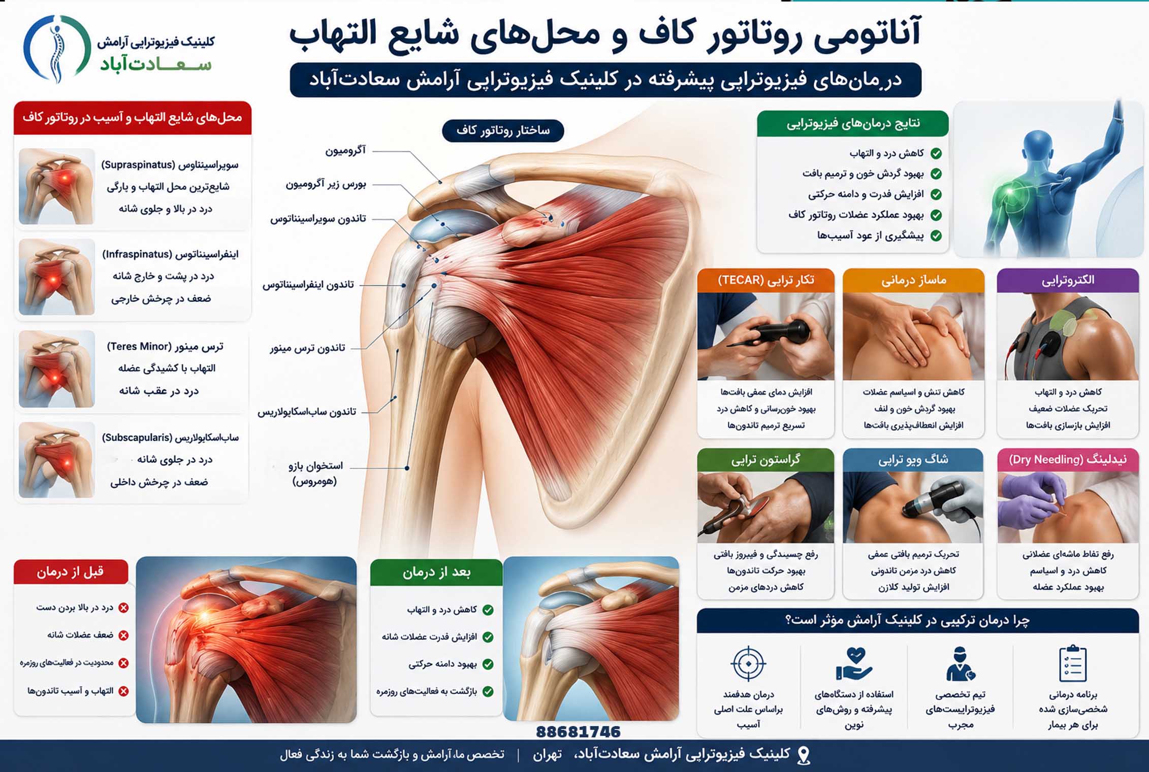 فیزیوتراپی چگونه به درمان درد شانه هنگام خواب کمک می‌کند؟